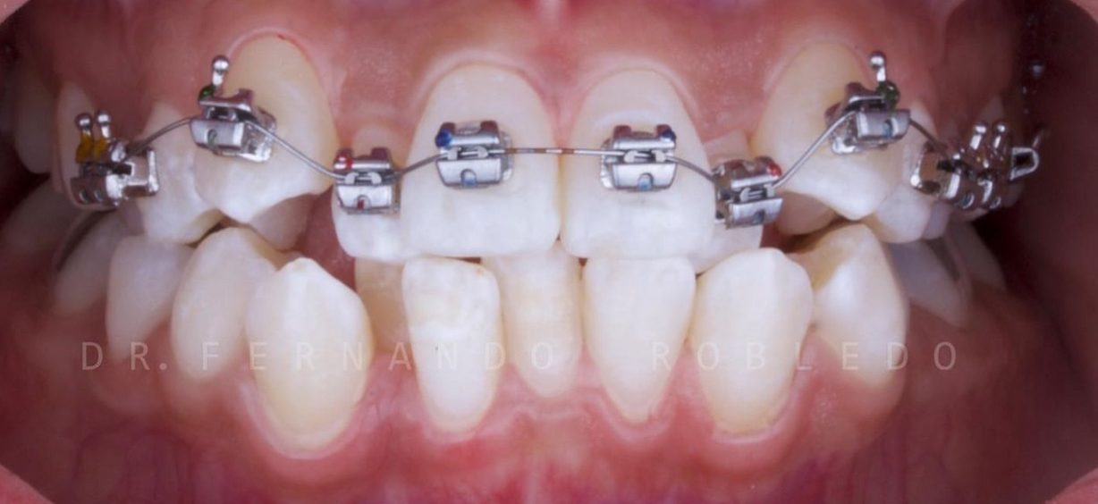 Antes del tratamiento, con brackets