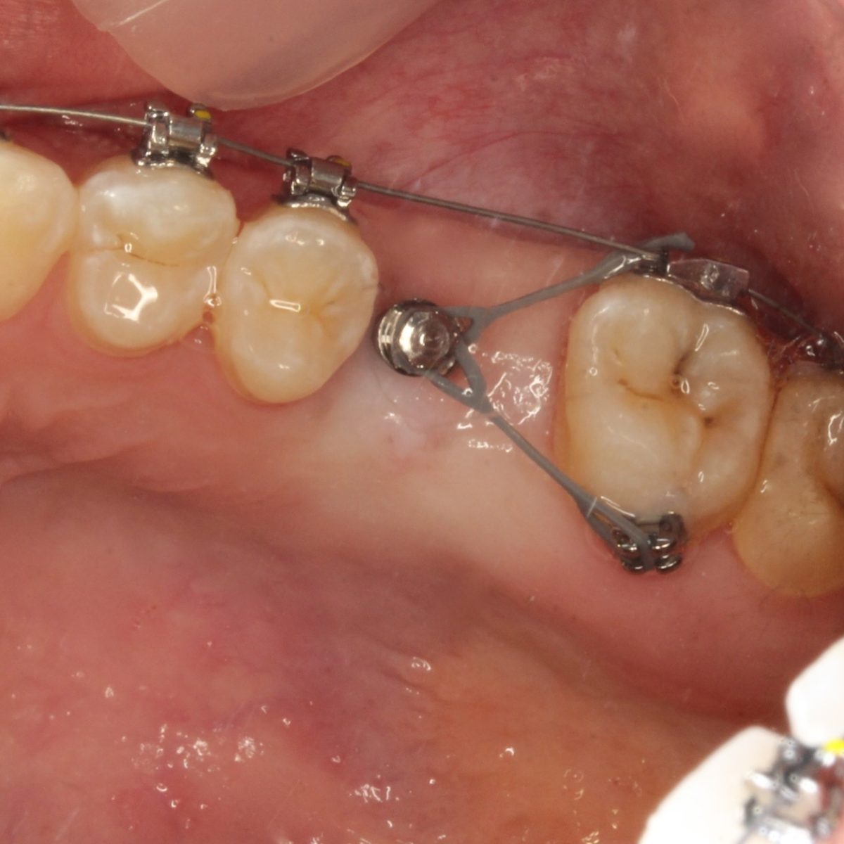 Detalle de un tratamiento de ortodoncia con anclaje
