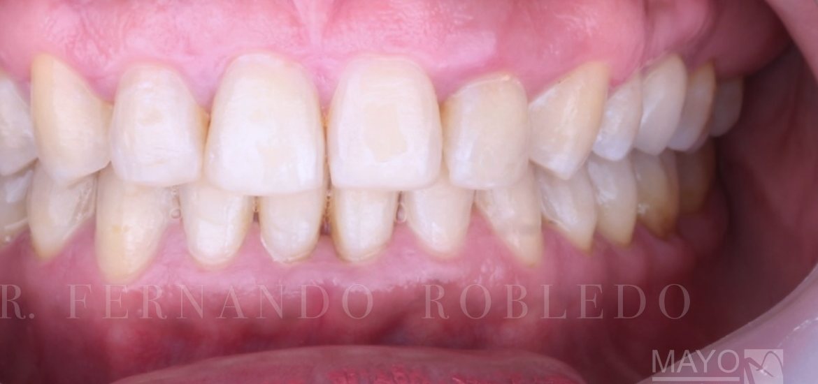 Resultado final de un tratamiento de ortodoncia en Mayo Dental